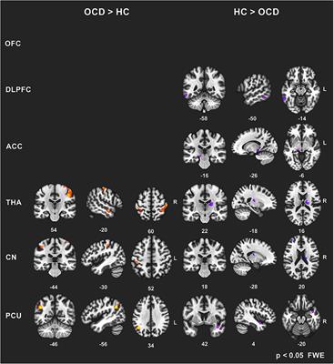 Functional Connectivity Changes in Obsessive–Compulsive Disorder Correspond to Interference Control and Obsessions Severity